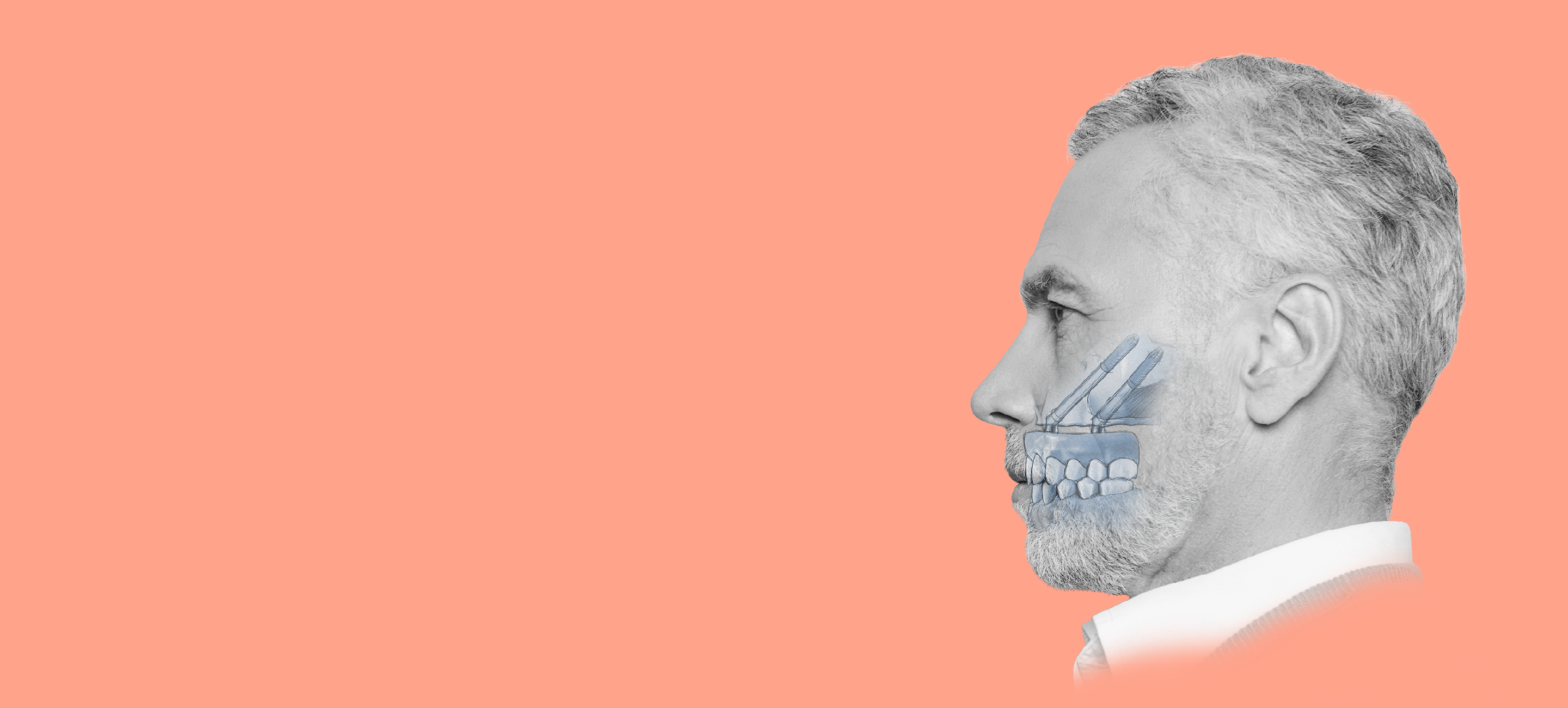 NobelZygoma
